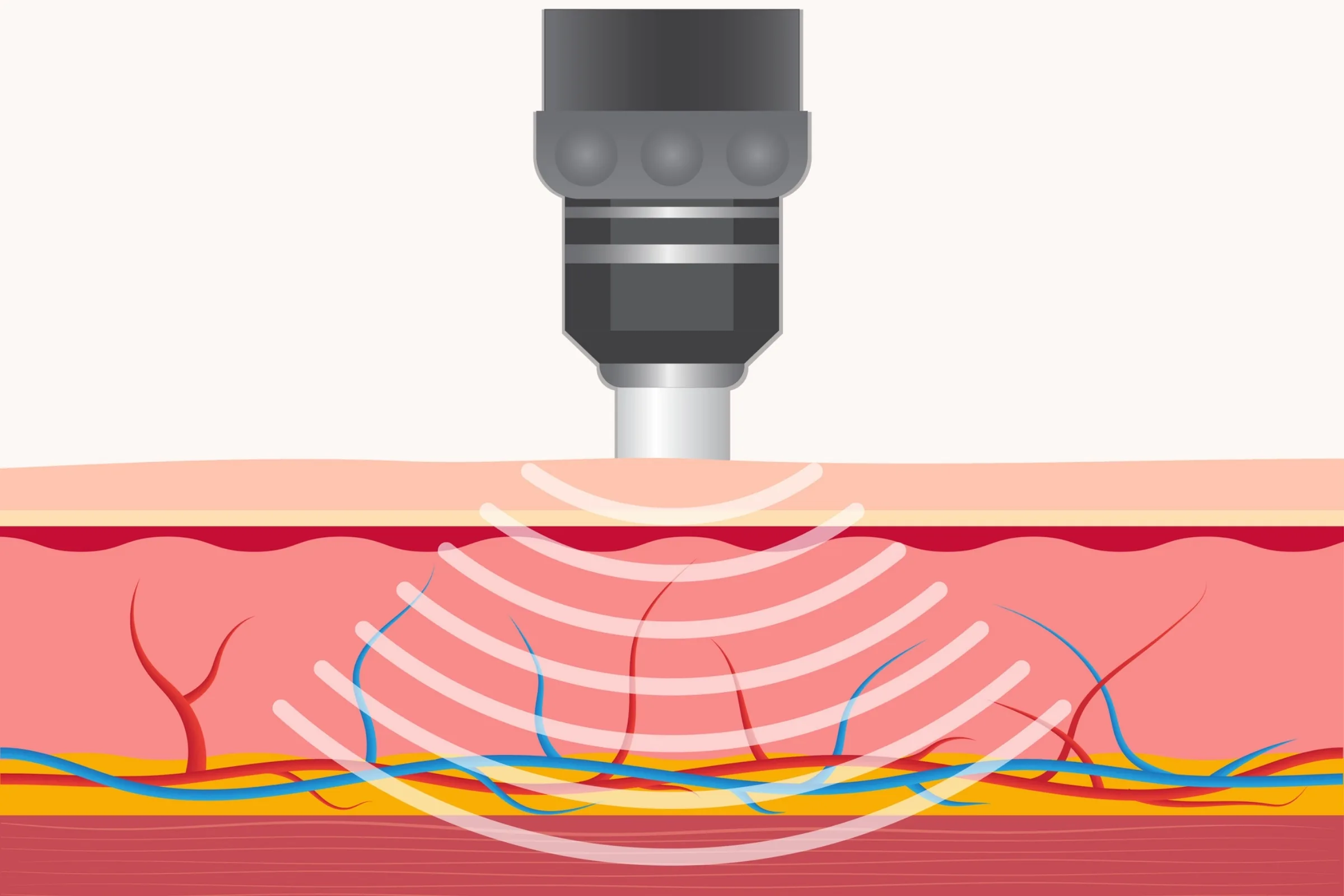 Shockwave therapy at a chiropractic office in La Quinta Shockwave therapy at a chiropractic office in La Quinta